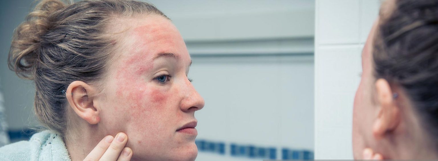 Acupuncture For Eczema Symptoms TCM Centre